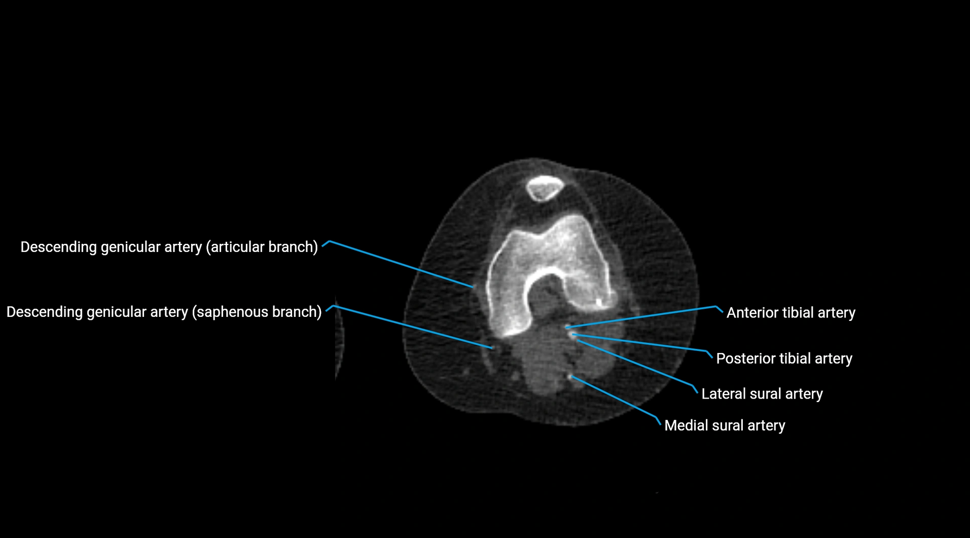 CTA lower limb cross sectional anatomy labelled image _174.webp